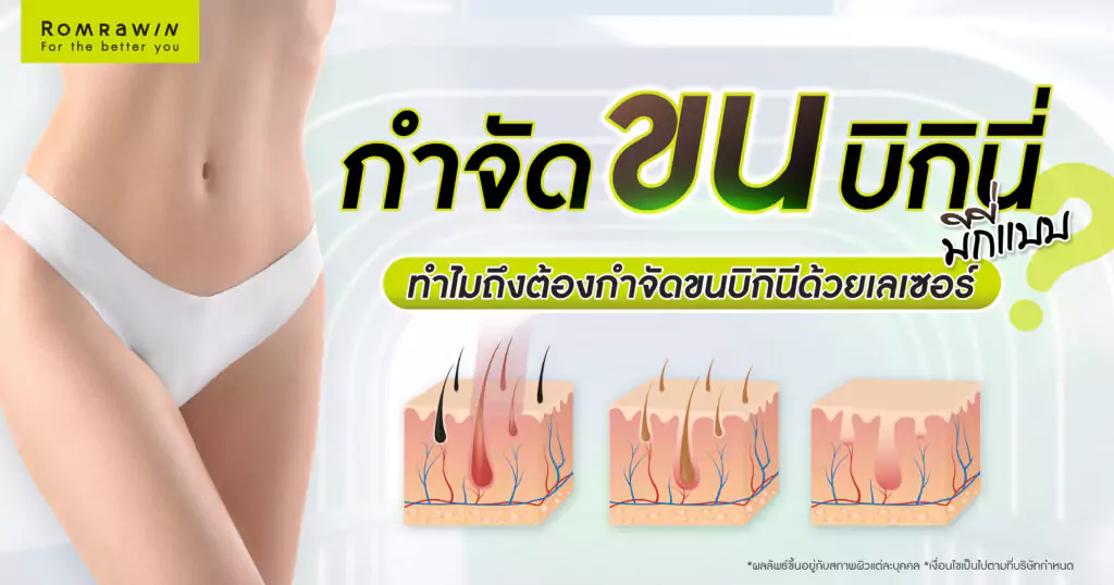 กำจัดขนบิกินี่คืออะไร ?