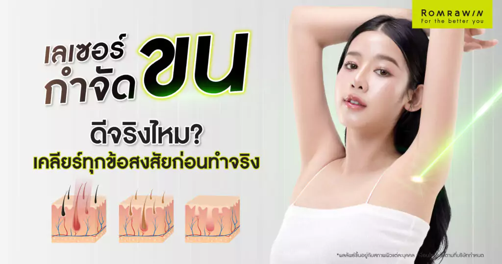 เลเซอร์กำจัดขนดีจริงไหม ? เคลียร์ทุกข้อสงสัยก่อนทำจริง 1 เลเซอร์กำจัดขนดีจริงไหม ?