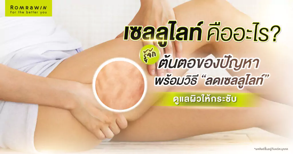 เซลลูไลท์ คืออะไร? รู้จักต้นตอของปัญหา พร้อมวิธีลดเซลลูไลท์ดูแลผิวให้กระชับ 1 เซลลูไลท์ คืออะไร