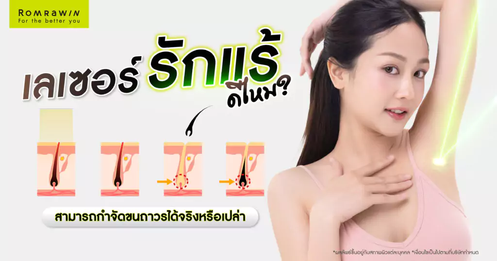 เลเซอร์รักแร้ดีไหม ? เลเซอร์ชนิดไหนดีกว่า อันตรายต่อผิวไหม 1 เลเซอร์รักแร้ดีไหม