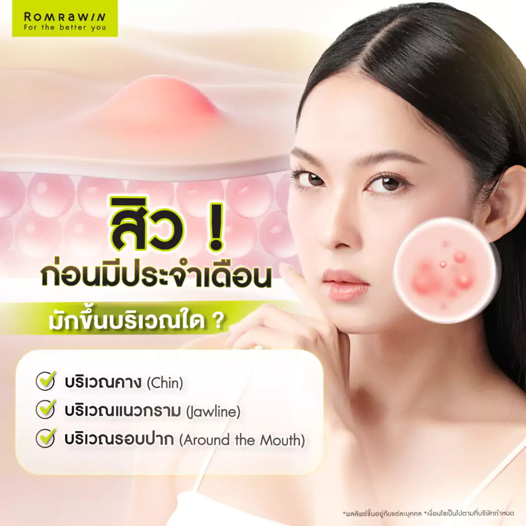 สิวขึ้นก่อนมีประจำเดือนมักขึ้นบริเวณใด ? 