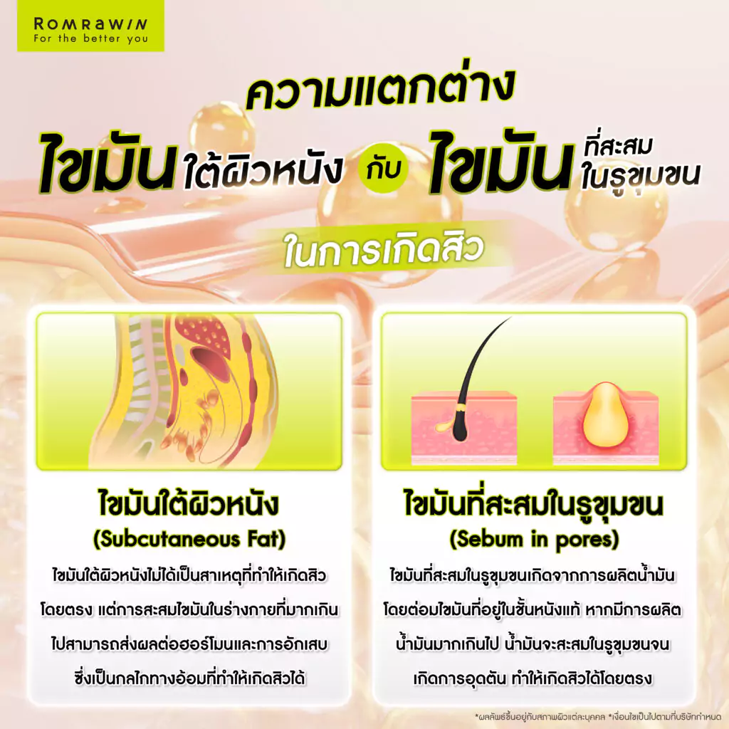 ไขมันใต้ผิวหนัง ปัจจัยแฝงที่ทำทำให้เกิดสิว 4 ความแตกต่างระหว่างไขมันใต้ผิวหนัง กับ ไขมันที่สะสมในรูขุมขนในการเกิดสิว