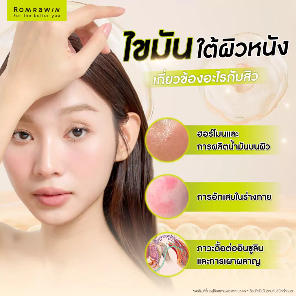 ไขมันใต้ผิวหนัง ปัจจัยแฝงที่ทำทำให้เกิดสิว 5 ไขมันใต้ผิวหนังเกี่ยวข้องอะไรกับสิว