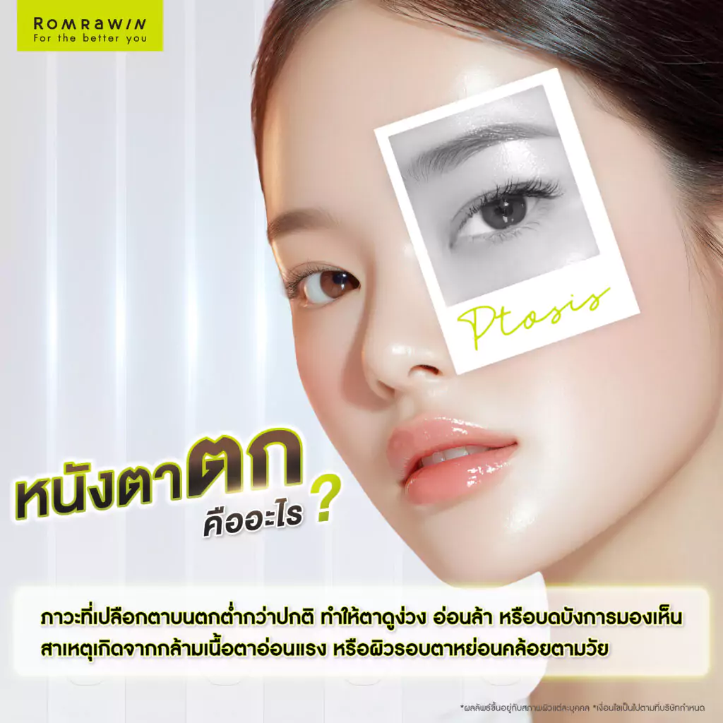 หนังตาตก แก้ปัญหาอย่างไร รวมวิธีดูแลดวงตากลับมาดูสดใสอีกครั้ง 2 หนังตาตก คืออะไร?