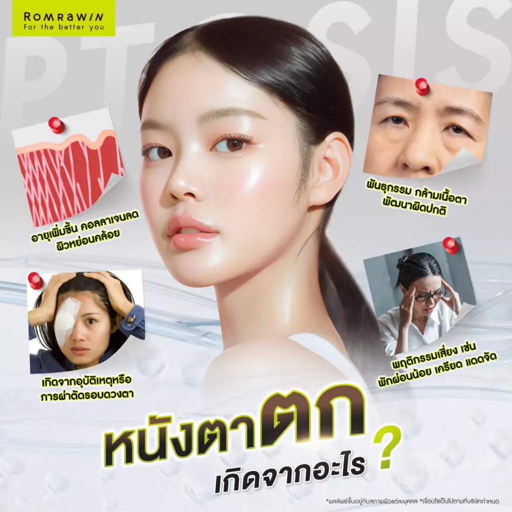 หนังตาตก แก้ปัญหาอย่างไร รวมวิธีดูแลดวงตากลับมาดูสดใสอีกครั้ง 3 หนังตาตก เกิดจากอะไรบ้าง?